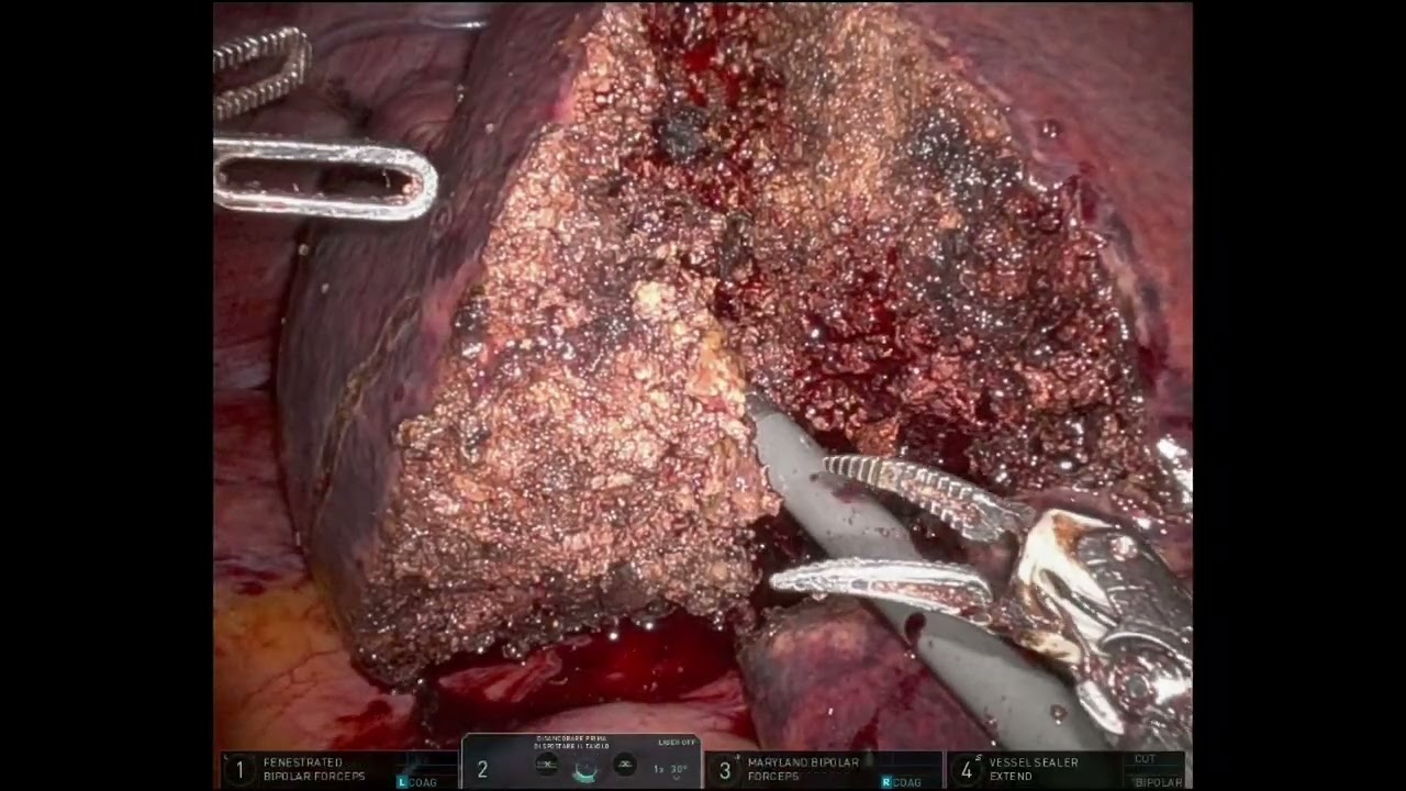 Syncronous single docking full robotic liver resection and leftc colectomy for colorectal cancer