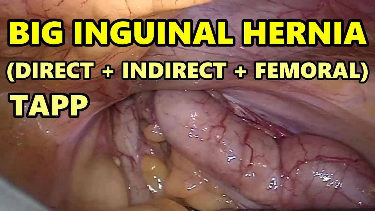 Department Of Surgery Inguinal Hernia Pediatric