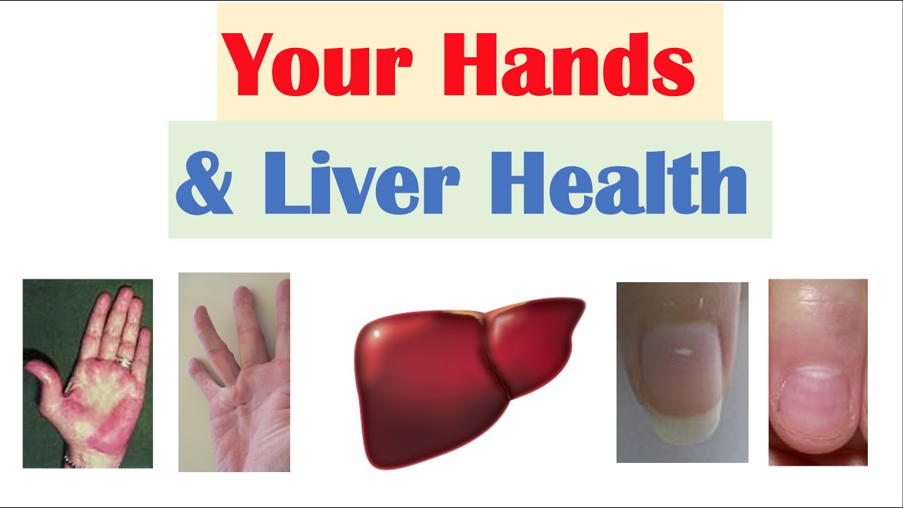 Your Hands \U0026 Liver Health | What Your Hands Can Tell You About Your Liver Health