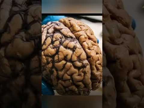 بسبب قله النوم ياكل الدماغ نفسها واعراضه تشابه اعراض الزهايمر