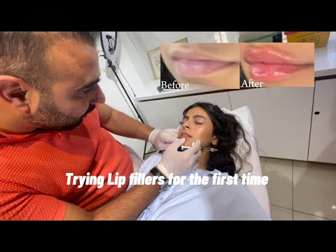       1  جربت فيلر الشفايف لأول مرة