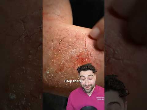 How to cure Eczema PERMANENTLY?!