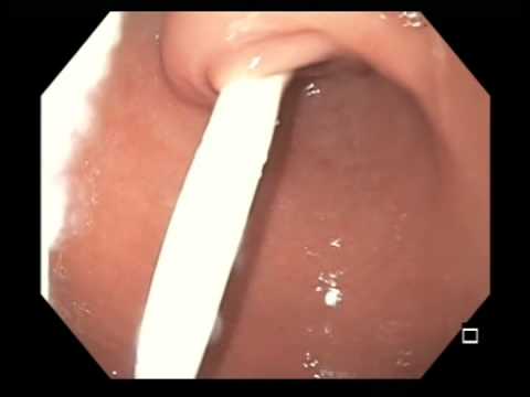 gastric outlet obstruction from post pyloric gastrostomy tube from gastric outlet obstruction