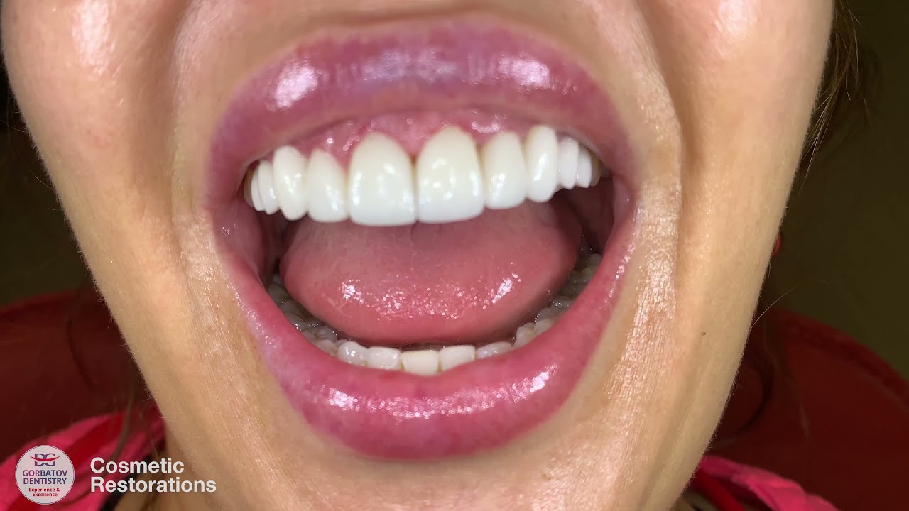 Cosmetic Restorations Veneers, Gum Lifting and Teeth Reshaping YouTube