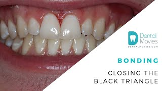 Bonding - closing the black triangle 🦷 Does Composite Bonding Work For Black Triangles Aka Bone Loss No District Dental Surgery