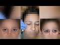 Dr monisha kapoor  how to remove eye dark circles  best treatment