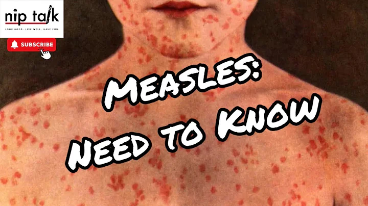 Measles Outbreak: What You NEED to Know in 2025