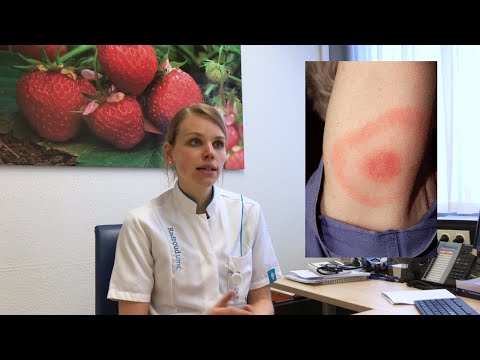 Video: Erythema Migrans - Behandeling, Oorzaken En Symptomen