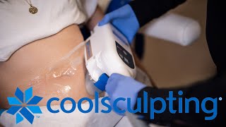 3 Benefits of CoolSculpting