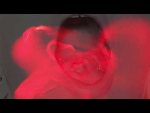 Teaser - Fracture