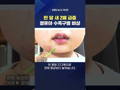 #수족구병 #영유아 병원 질병 <strong>어린이집</strong> 유치원 고열 감염 여름 최위지기자
