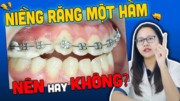 Niềng Răng 1 Hàm Nên Hay Không? 5 Trường Hợp "Cấm" Niềng Răng 1 Hàm?