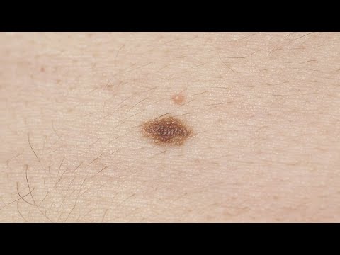 Melanoma symptoms: How to spot signs, and when to see a doctor