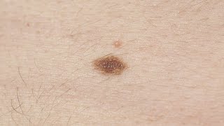 Melanoma symptoms: How to spot signs, and when to see a doctor