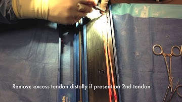 ACL Reconstrucion  SM