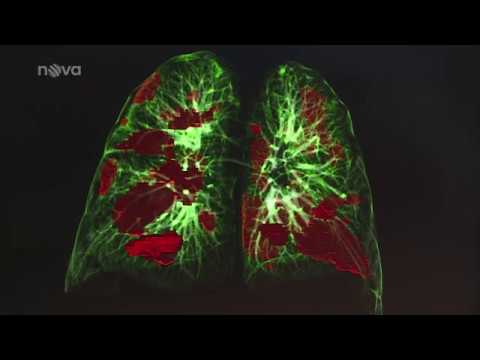 Video: Koronavirem je poškození plic 70 procent