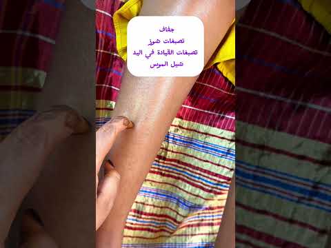 حل تصبغات اليد والرجل والجفاف بمنتجات نوارة