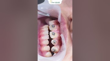 Cận cảnh gắn mắc cài tròn bắt đầu hành trình niềng răng!