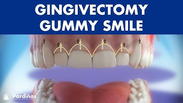 Gingivectomy - Treatment for gummy smile ©