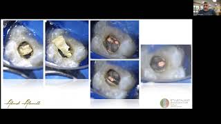Magnification in Endodontics: Accessory or Substantial?