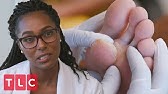 A Patient With Wart Clusters My Feet Are Killing Me Youtube A Patient With Wart Clusters My Feet Are Killing Me Youtube