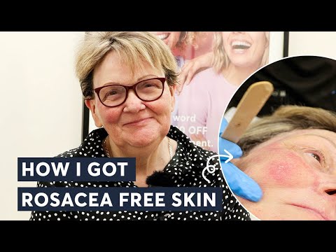 Gone in a Flash: Erase Rosacea with This Laser Trick