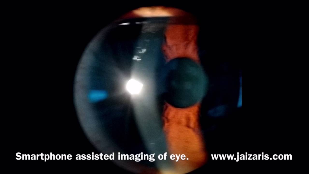 Jaiz AIM. Smartphone assisted imaging of anterior segment