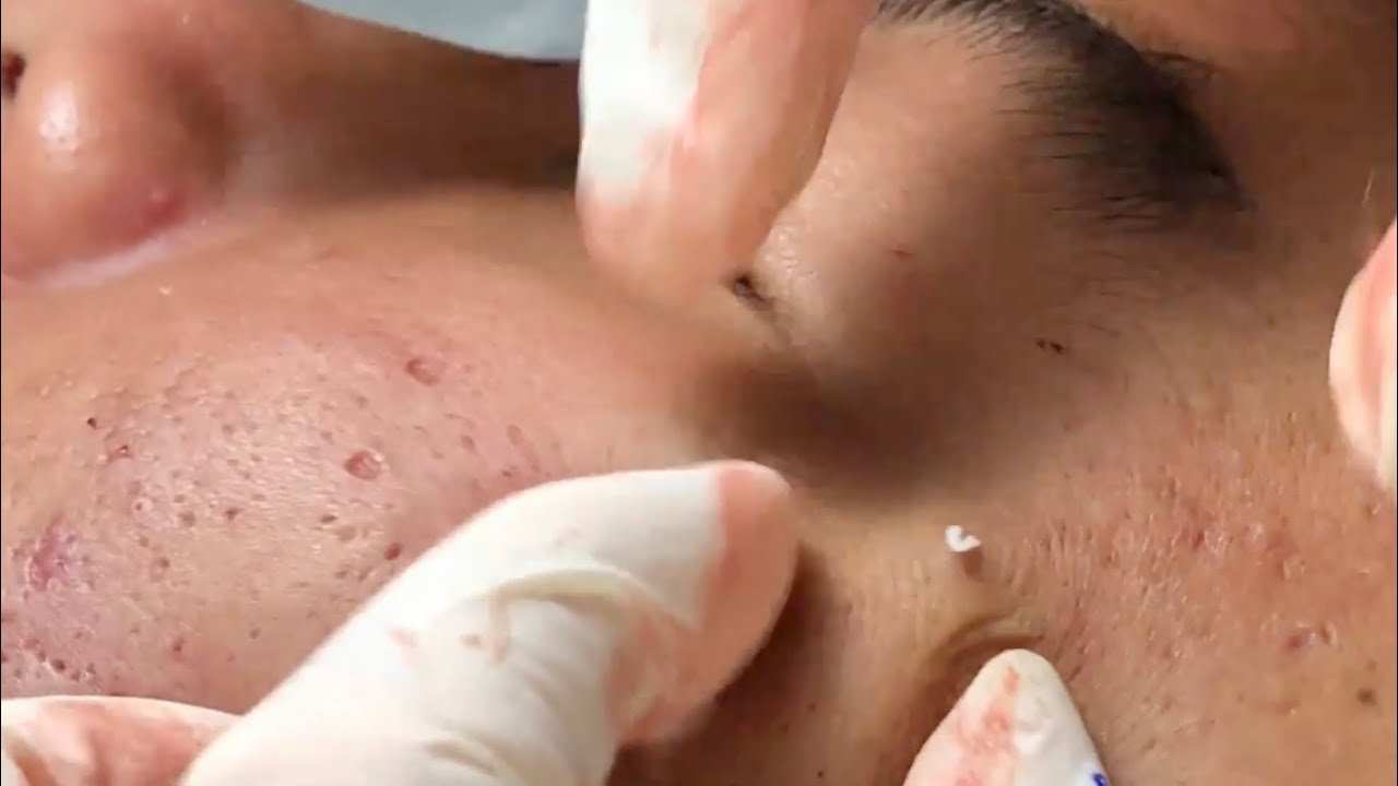 Pimple Popping 2020 Video 35 Blackhead removal, Whitehead removal