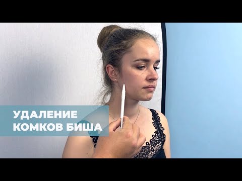 Удаление комков Биша. Совет пластического хирурга центра Certus [2020]