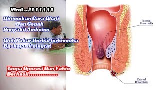 Obati  ambeien tanpa operasi #bayudiningrat Pakar Herbal Indonesia