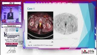 Yousef Amr - TRUS Guided Biopsy after PSMA PET CT inResidual/Recurrent Prostate Cancer- Is it Time