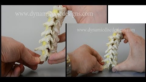 Cervical Hypermobility Model | Instability of Vertebrae