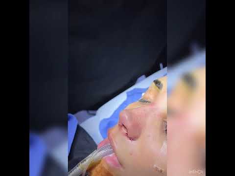 Video thumbnail: 5D Nose Approach - Rhinoplasty - Before & Immediately After · Dr. Anil Shah