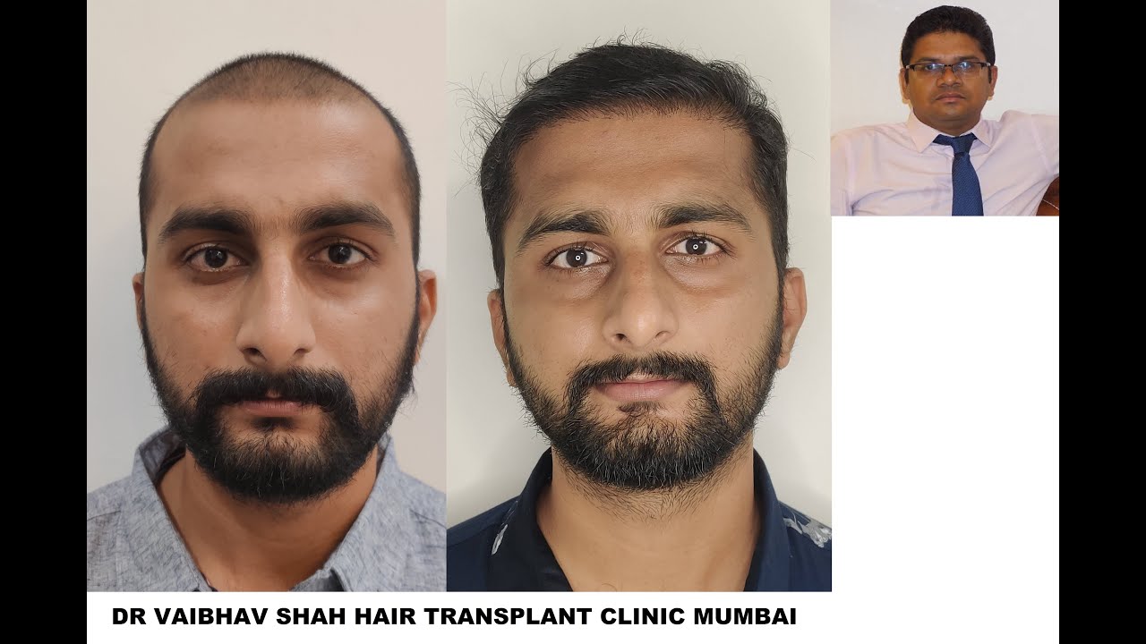 Anagen Hair Transplant Hair Transplant Surgery Clinic in Andheri West  Mumbai  Book Appointment View Fees Feedbacks  Practo