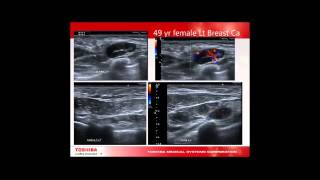 Breast Webinar with Louise Worley