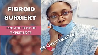 Fibroid Surgery:Behind the Scene of my Abdominal Myomectomy& Recovery Day 1- Week 2 *Graphic Content