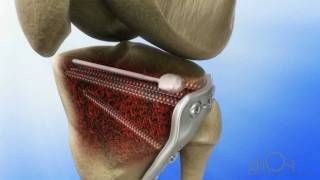Ghost Productions - Medtronic - Tibial Plateau Inflatable Bone Tamp