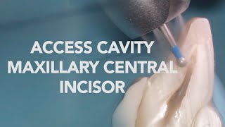 Endodontic Access Cavity of Maxillary Central Incisor - Occlusal & Sectional View