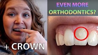 Crown Is In &amp; Orthodontic Button to Level Front Teeth
