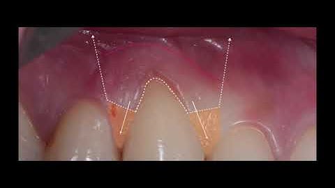 ROOT  COVERAGE PROCEDURE (coronally advanced flap + connective tissue graft)