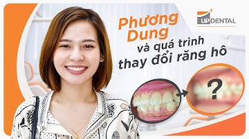 Phương Dung và quá trình thay đổi răng hô