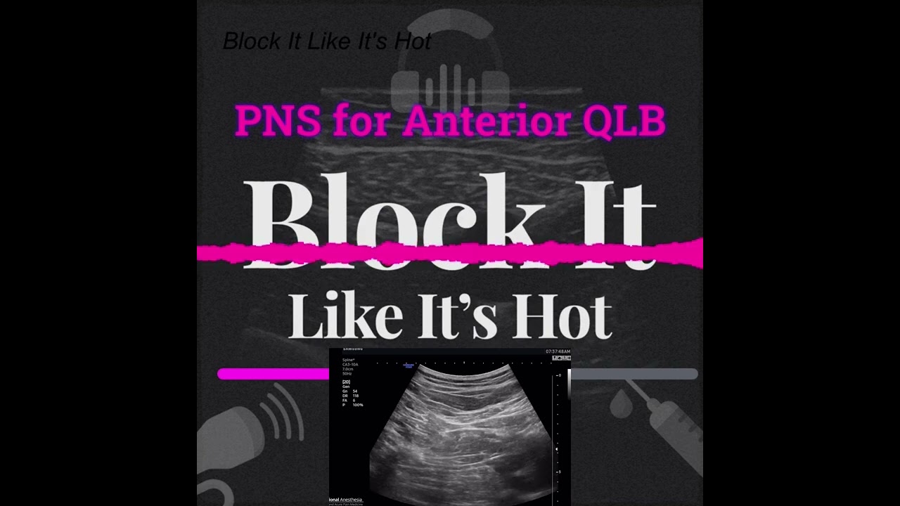 Jeff’s Secret to Identify the Anterior QL Plane Revealed