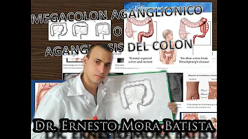 ¿Cuáles son los signos y síntomas del megacolon?