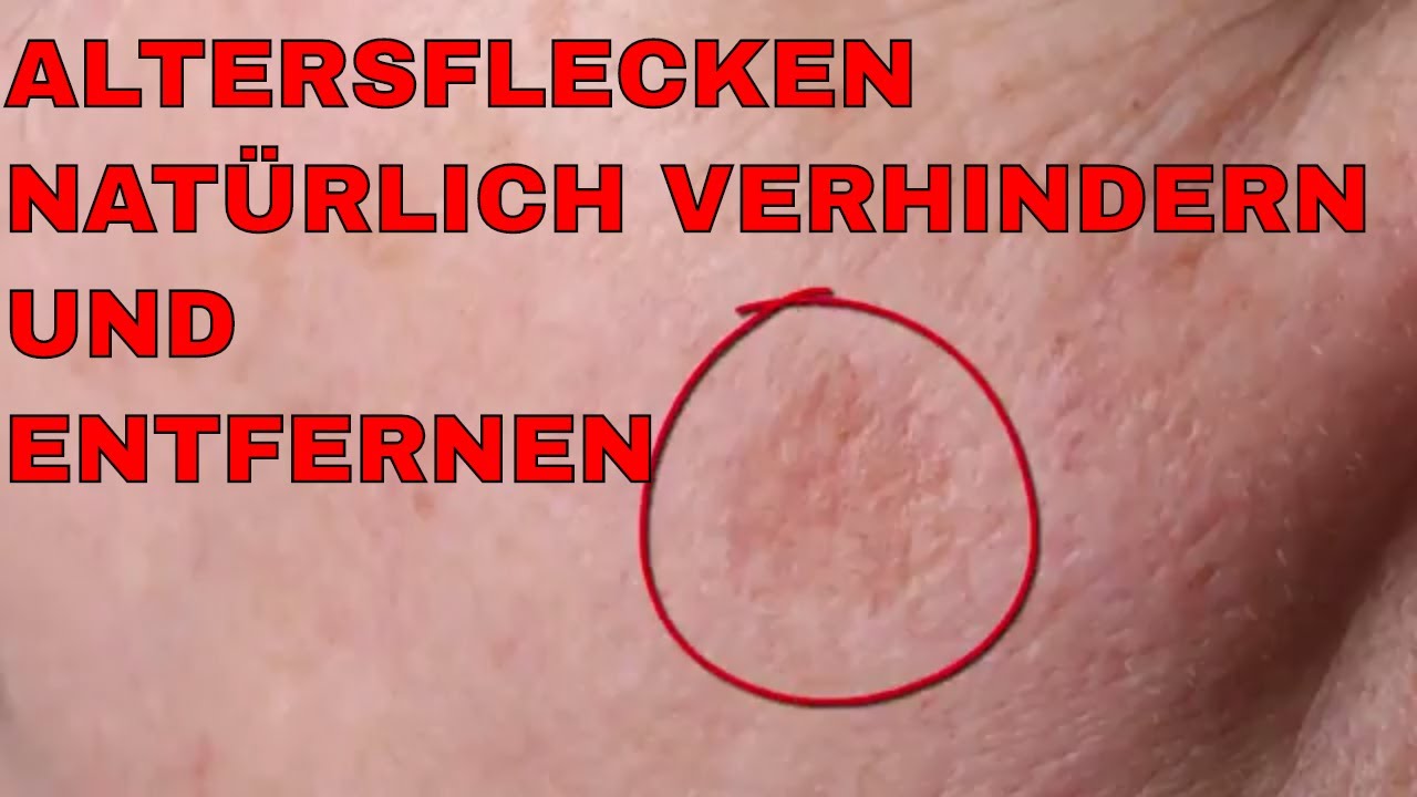 Altersflecken Entfernen Altersflecken Entfernen