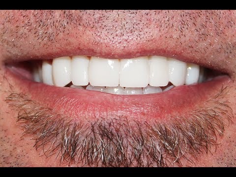 Video Procedure of Invisalign with Dental Veneers at ... Video Procedure of Invisalign with Dental Veneers at ...