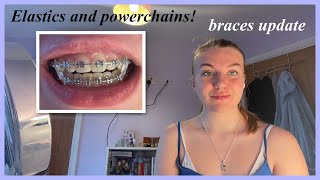 Getting elastics and powerchains put on?!? BRACES UPDATE 7 months!🤍