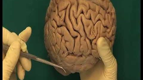 1.6 Step 1. Cerebral hemispheres, lobes, fissures, gyri and sulci