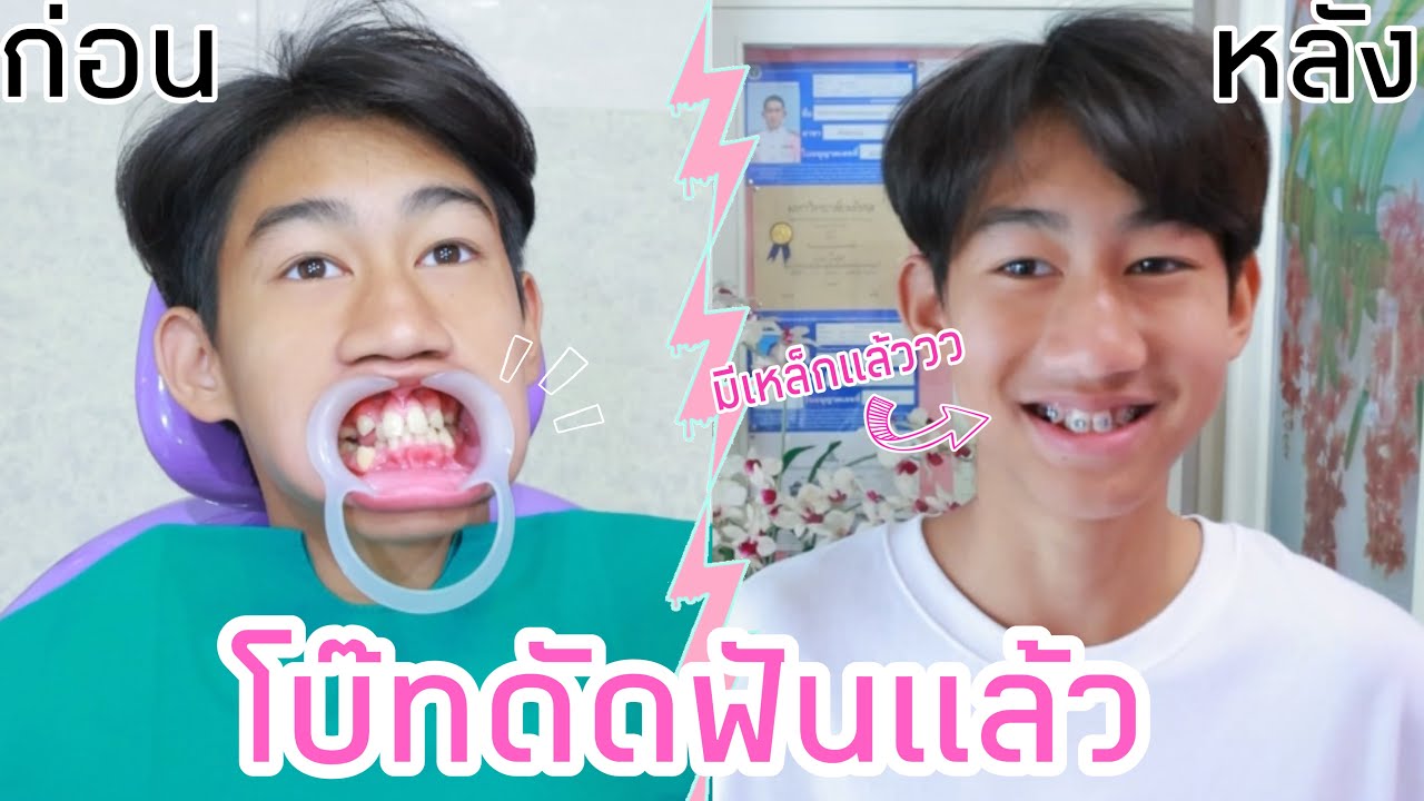 โบ๊ทดัดฟัน ครั้งแรกในชีวิต!! (EP.1) ใส่เหล็กแล้วว