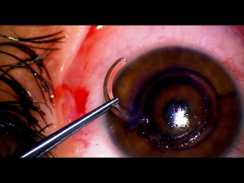 Keraring Keratoconus Surgery: Asymmetric Thickness Intrastromal Corneal Ring Segment Implant