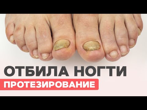 Протезирование ногтя на ноге в домашних условиях